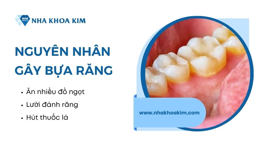 nguyên nhân gây bựa răng