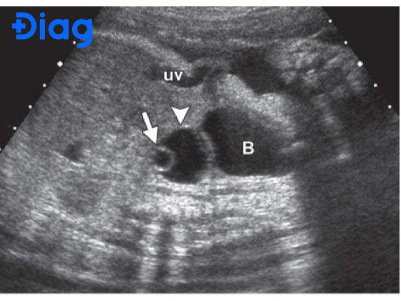 nang echo trống buồng trứng trái