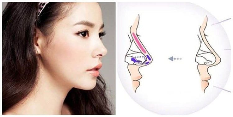 Mô sụn hyalin có thể tìm thấy trong vách ngăn của mũi