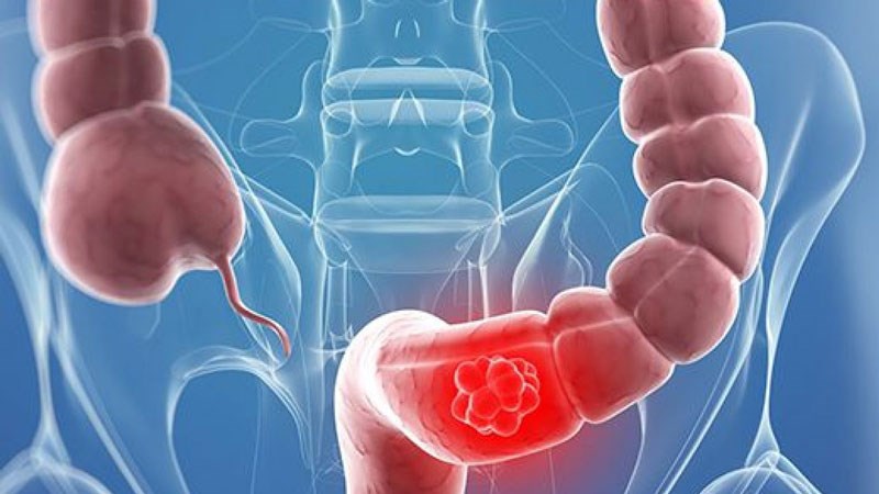 Chiết xuất củ riềng có tác dụng điều trị tích cực trong viêm loét đại tràng