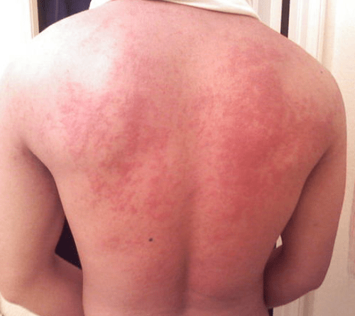 Biểu hiện của bệnh dị ứng lúa mì