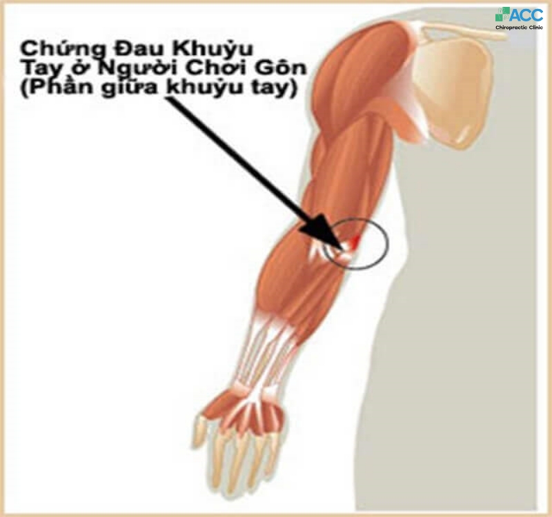 viêm khớp khuỷu tay