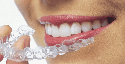 Khay niềng răng của Invisalign tháo lắp linh hoạt, thuận lợi cho việc vệ sinh