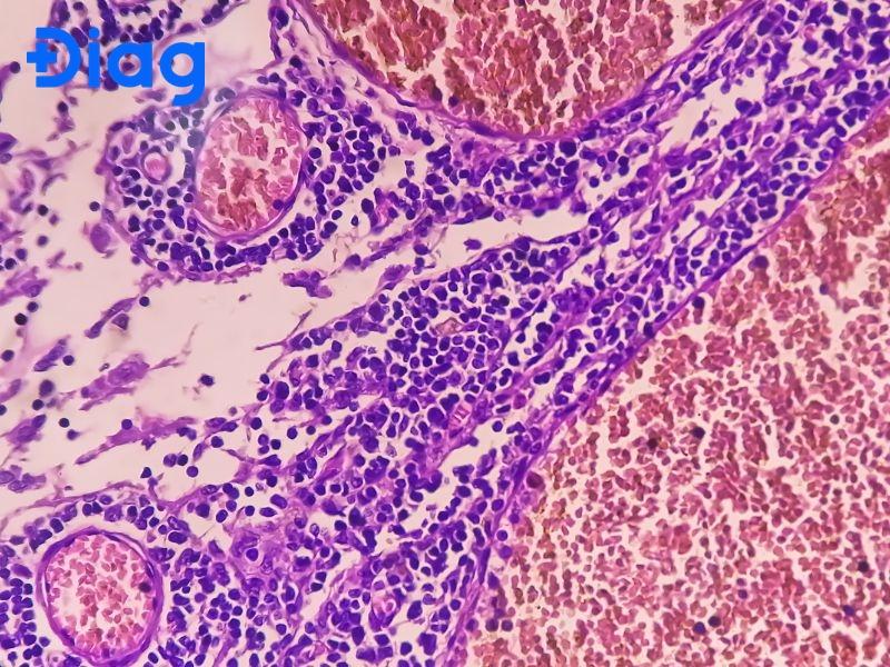 Ung thư biểu mô tuyến kém biệt hóa là tình trạng tế bào ung thư mất đa số cấu trúc đặc trưng của tuyến, không còn hình thái và chức năng bình thường.