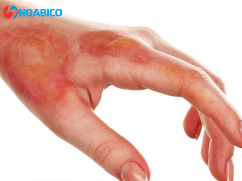 Mức độ độc hại của NaOH (Xút ăn da)