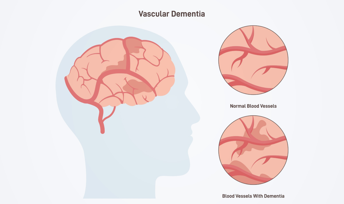 Bệnh Alzheimer, đừng đợi mất trí nhớ.