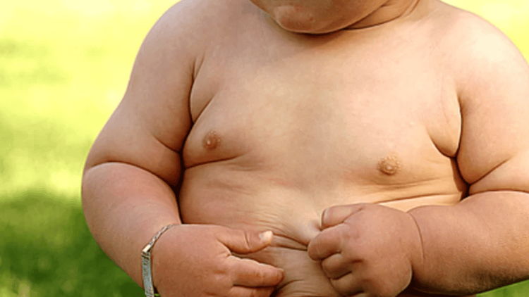 Hội chứng Prader-Willi - một trong các đột biến nhiễm sắc thể - gây biến chứng béo phì.