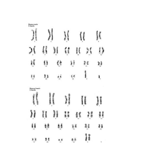 Karyotype bình thường ở nam giới và nữ giới (Cytogenetics Gallery).