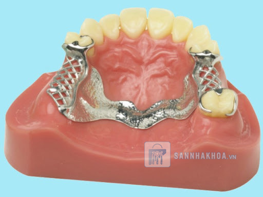 Hàm khung titan và những ưu điểm sử dụng