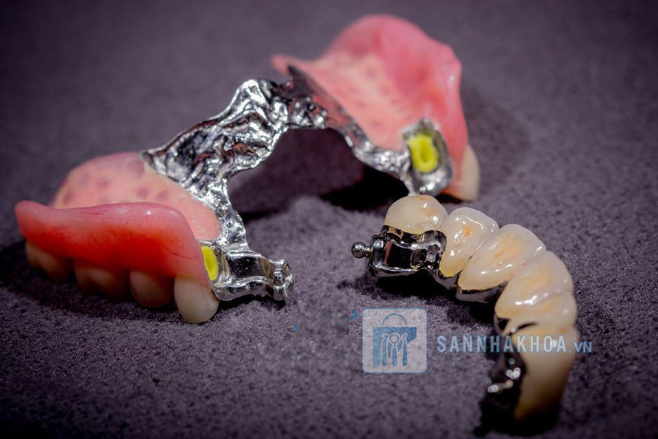 Khám phá đặc điểm của từng loại hàm khung trong nha khoa