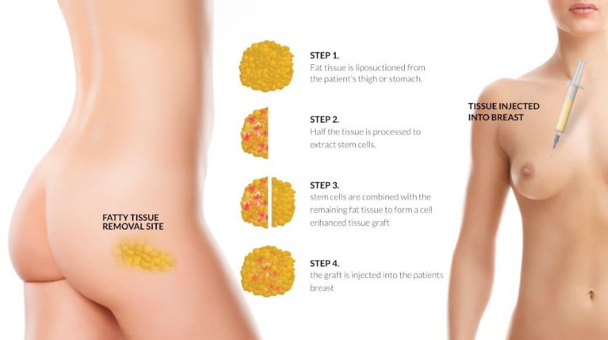 nâng ngực bằng mỡ tự thân