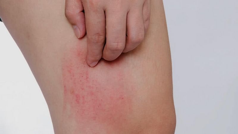 Natri Clorua khá an toàn nhưng một số người dị ứng với chất này có thể gây kích ứng da