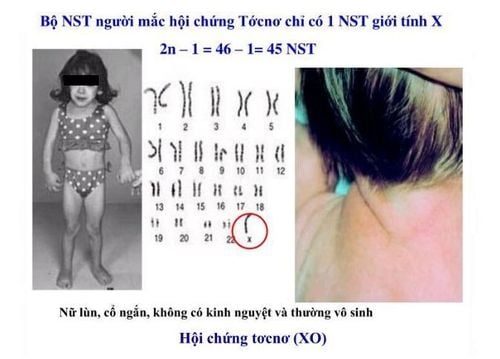 Người mắc phải hội chứng Turner có chiều cao khiêm tốn