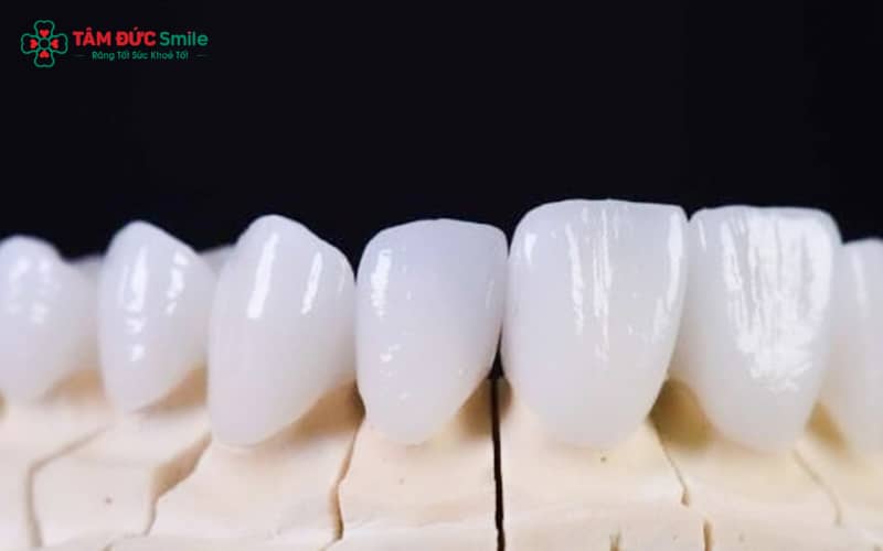 Răng sứ Venus có độ bền cao, chịu lực tốt, đảm bảo sử dụng lâu dài nếu chăm sóc đúng cách