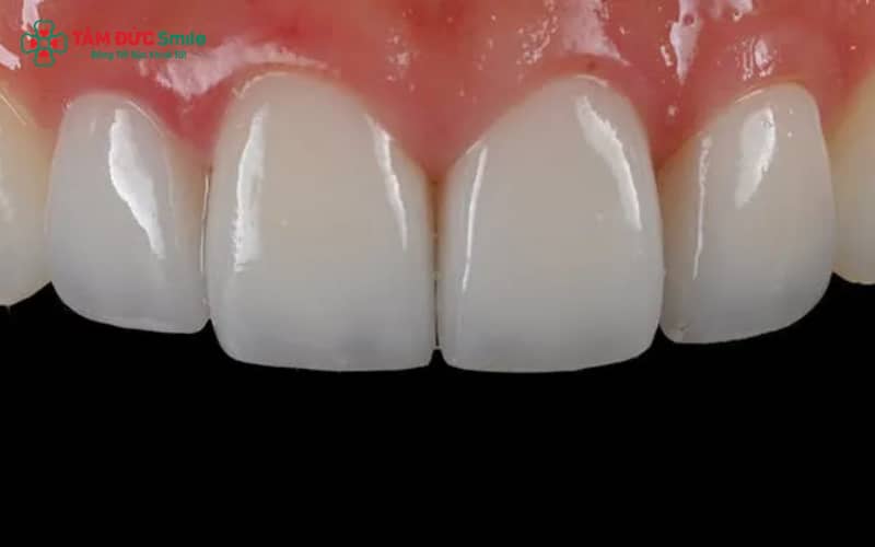 Răng sứ Venus nổi bật với thẩm mỹ tự nhiên, an toàn, không đen viền nướu và độ bền vượt trội