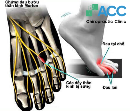 chứng đau bàn chân