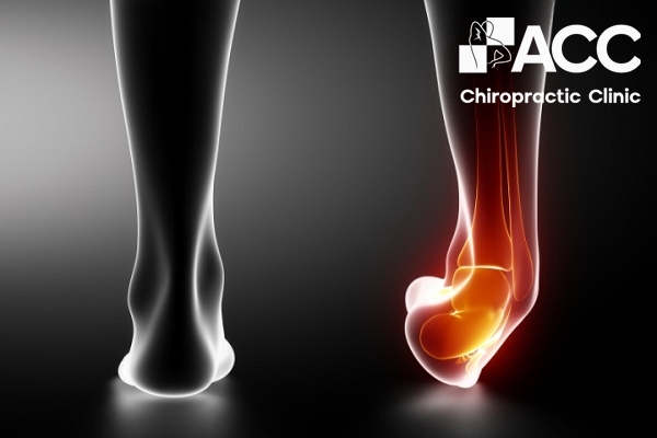 đau bàn chân do bong gân