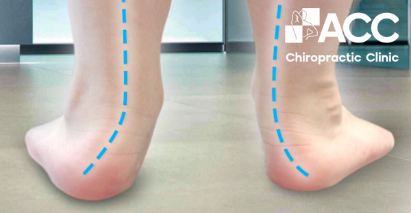 đau bàn chân do bàn chân bẹt