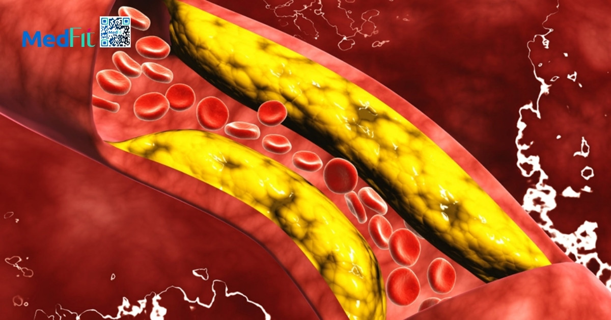 tiêu thụ fructose quá mức có thể làm tăng nguy cơ mắc bệnh tim mạch