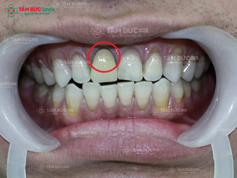 tac-hai-cua-rang-su-kim-loai-1