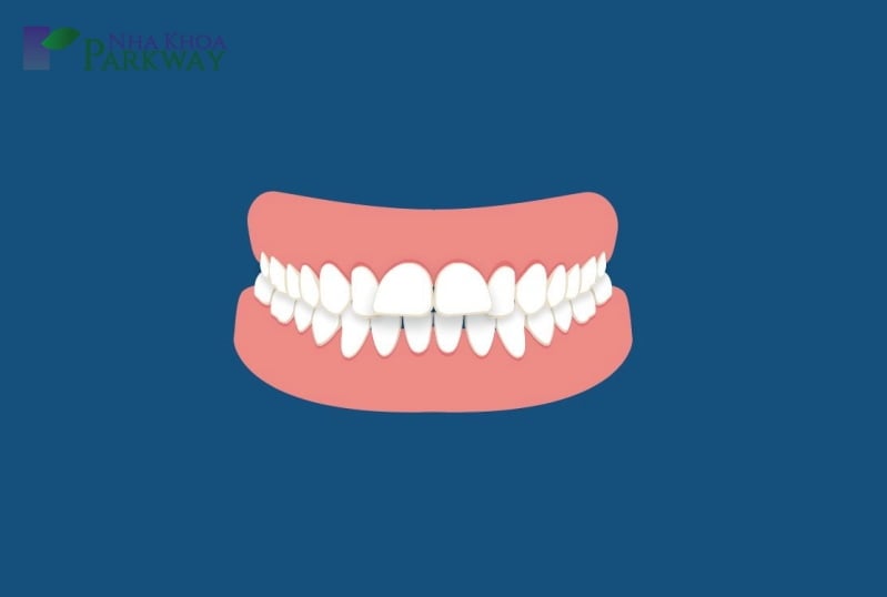 Răng hô tiếng anh là gì - 1