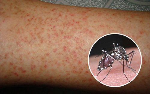 Virus Dengue gây bệnh sốt xuất huyết lây truyền từ người sang người qua con đường trung gian là muỗi vằn