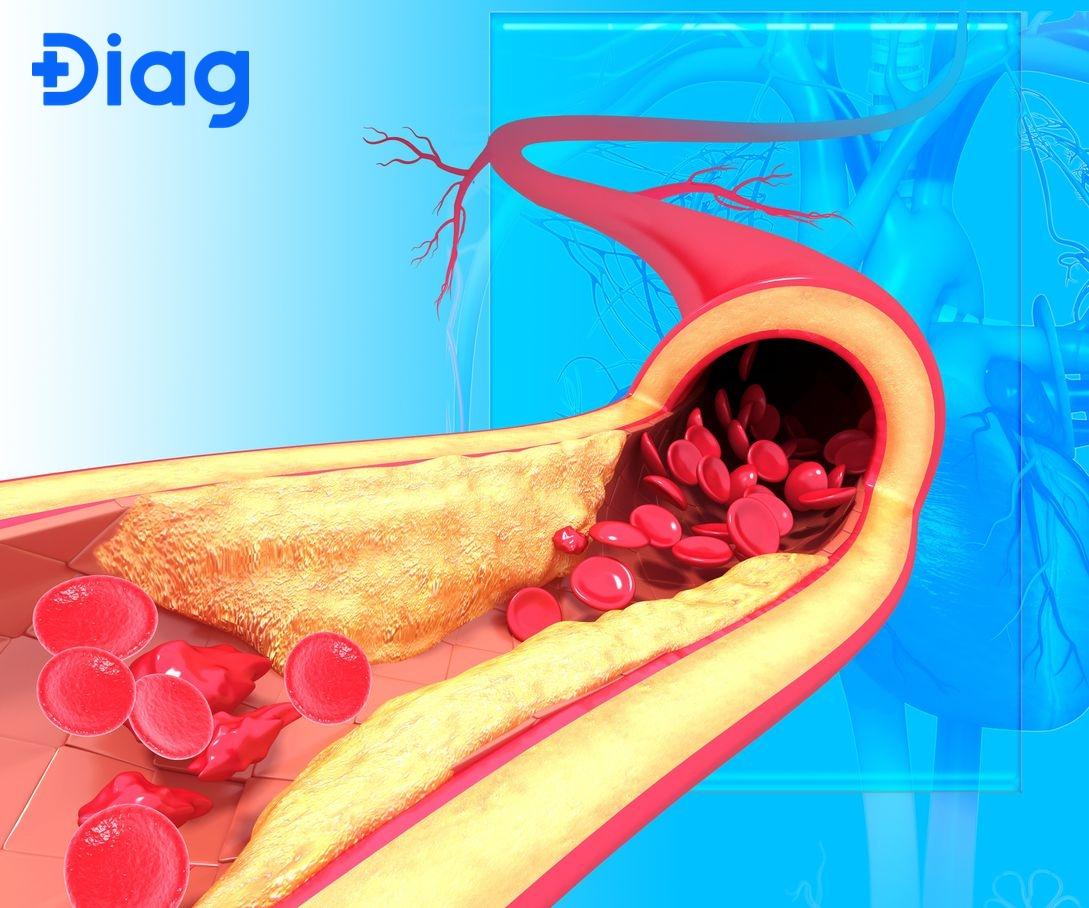 Bệnh mạch vành thường xảy ra do các mảng xơ vữa.