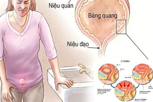 Viêm niệu đạo