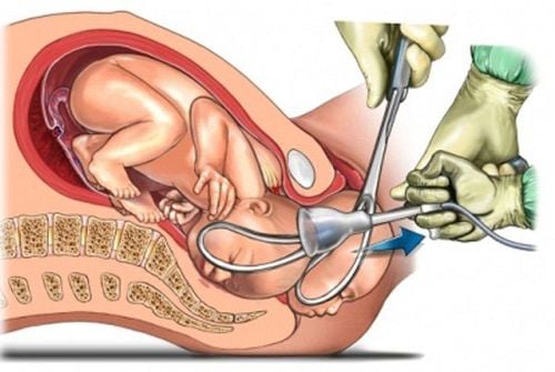 Sinh giúp bằng Forceps là thủ thuật hỗ trợ giúp sức cho sản phụ sinh trong giai đoạn sổ thai.