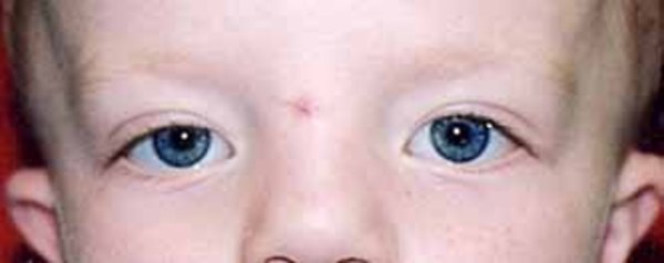 Photograph of the face of a child with widely spaced eyes.