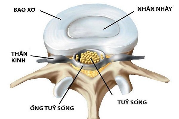 nhân keo của đĩa đệm