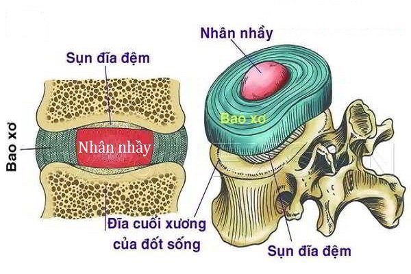 bao xơ của đĩa đệm