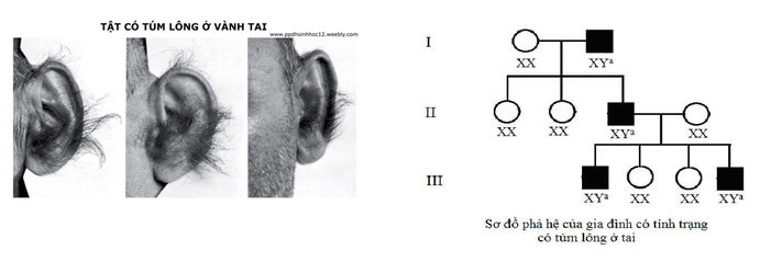 tật có túm lông ở tai do gen trên NST Y quy định - di truyền liên kết với giới tính