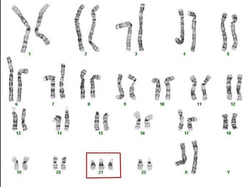 Bộ nhiễm sắc thể của người bị bệnh Down.