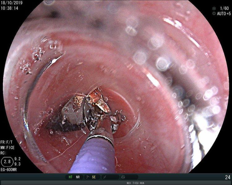 Phương pháp kỹ thuật nội soi lấy dị vật thực quản.