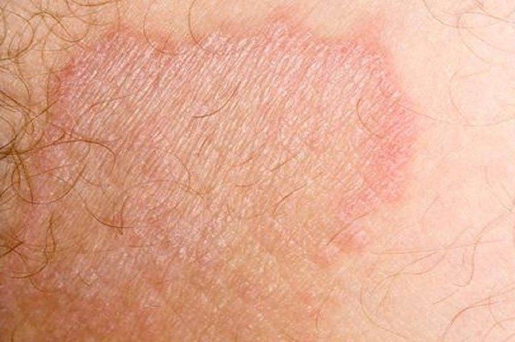 The patient may notice red patches and dry skin in the genital area.