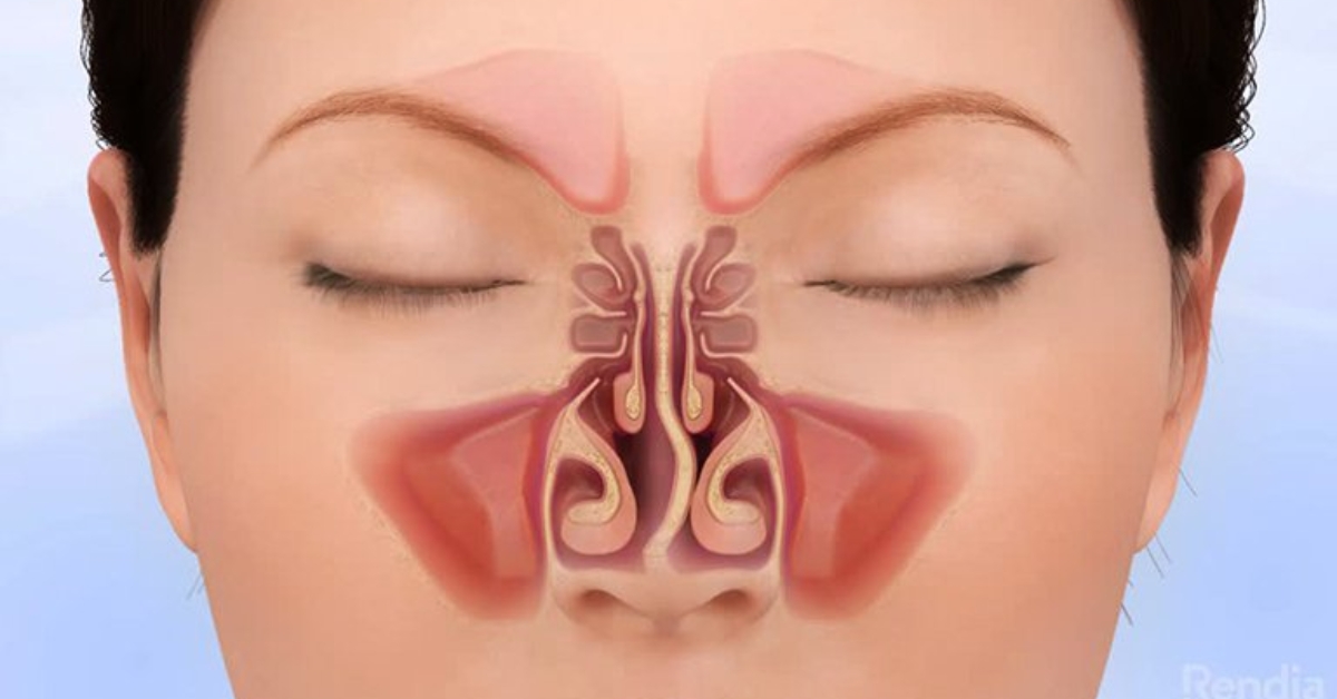 Lệch vách ngăn mũi khiến đường thở bị hạn chế gây ra tật thở miệng