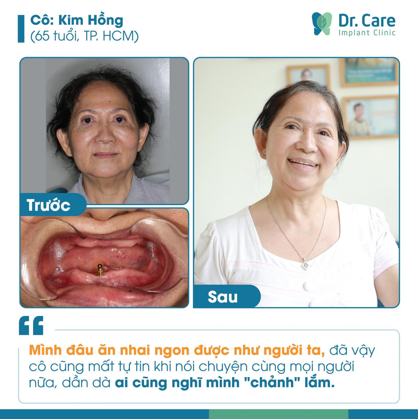 Trồng răng toàn hàm là gì?
