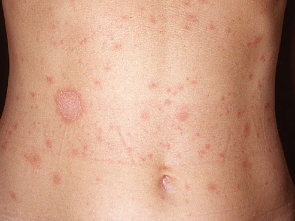 Triệu chứng phát ban khi nhiễm HIV/AIDS
