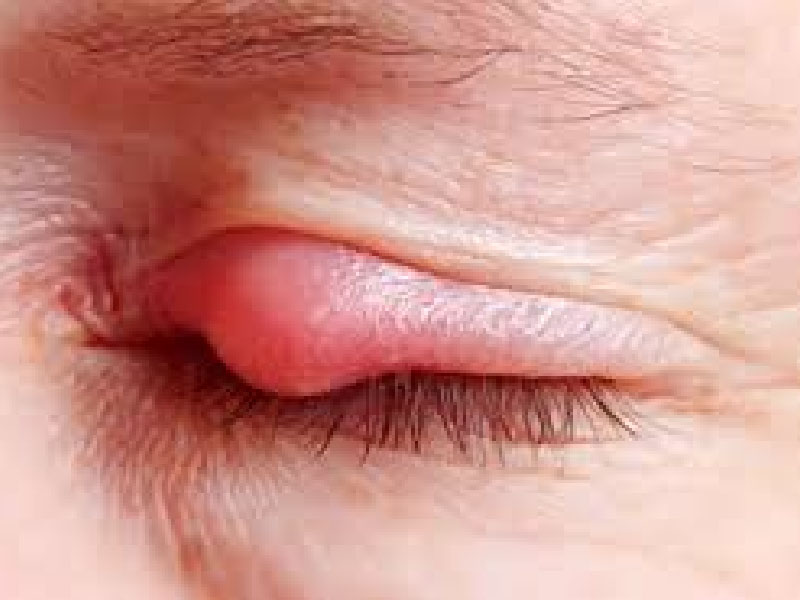Thoái hóa điểm vàng (ARMD hoặc AMD)