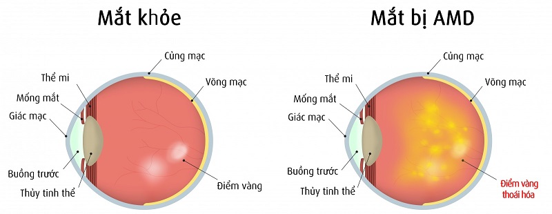 Ưu đãi đặc biệt dành cho khách hàng phẫu thuật mắt tại MEDLATEC