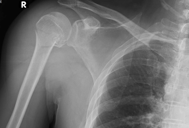 Vì sao xương trẻ nhỏ khi gãy thì mau liền hơn so với xương người lớn? 2
