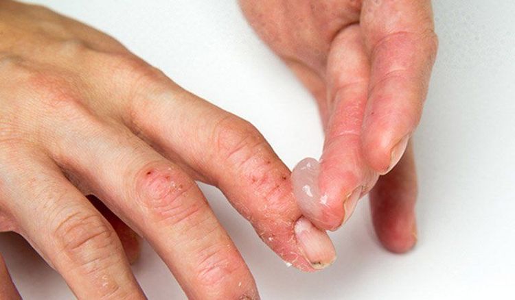 Dùng một số loại kem dưỡng ẩm giúp cải thiện tình trạng tróc da đầu ngón tay