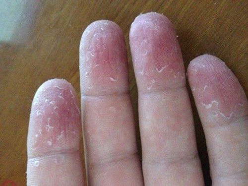 Tróc da đầu ngón tay có thể do rửa tay quá nhiều
