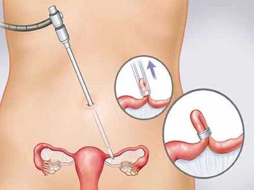 Biện pháp tránh thai nào là ít tác dụng phụ nhất chính là phụ thuộc vào từng cá nhân