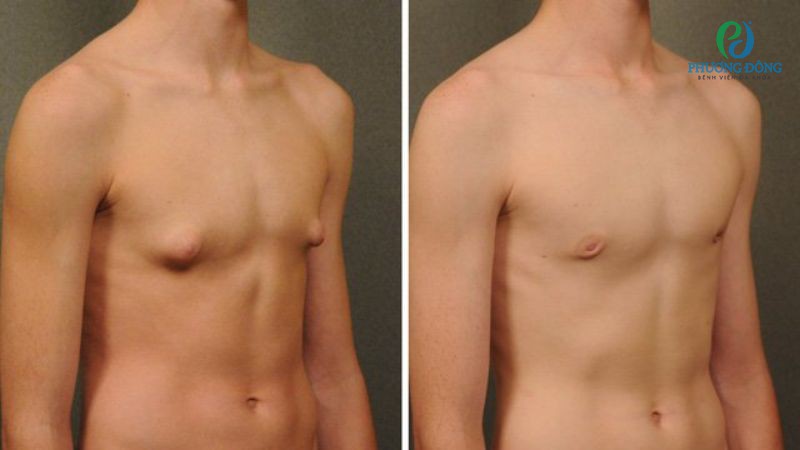 Chứng Klinefelter khiến tuyến vú nam giới phát triển mạnh