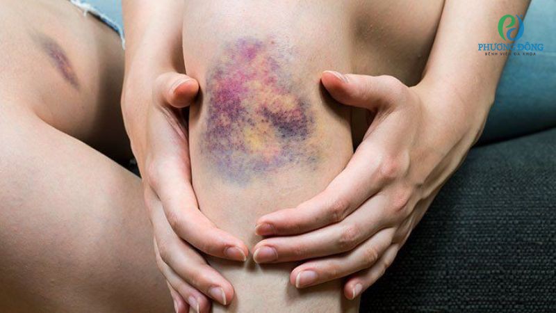 Hemophilie A là một bệnh rối loạn chảy máu di truyền trên NST X